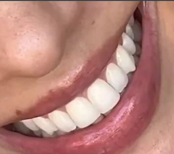 Sorriso branco
